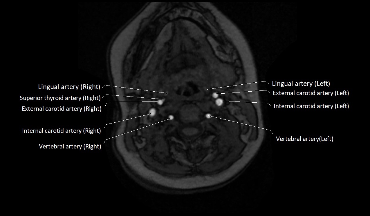 Carotid artery anatomy axial 3T image 25.jpg